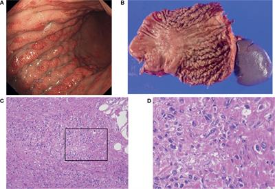 Crosstalk Between Cancer Associated Fibroblasts and Cancer Cells in Scirrhous Type Gastric Cancer